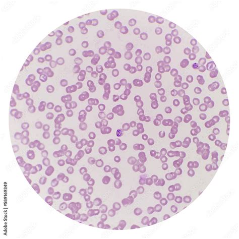  Babesia! A Tiny Terror Hiding in Plain Sight: Lurking Inside Red Blood Cells